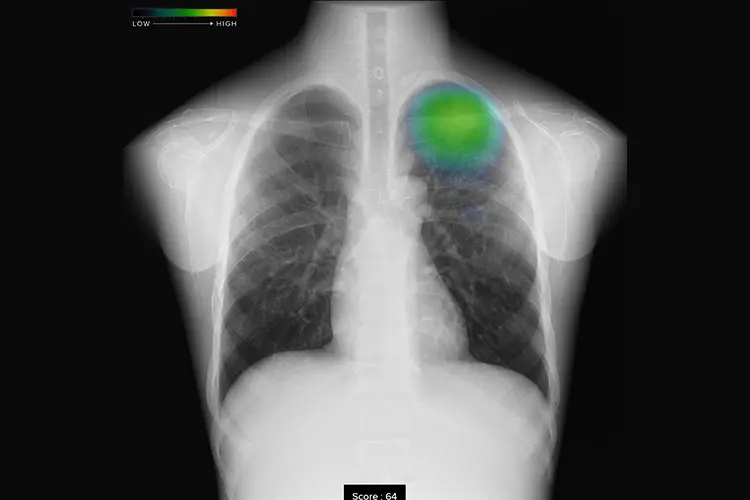 胸部X線画像病変検出AI